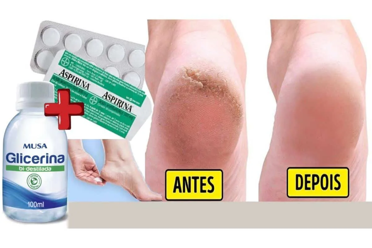 Aprendi a faze um hidratante caseiro para pés rachados que é