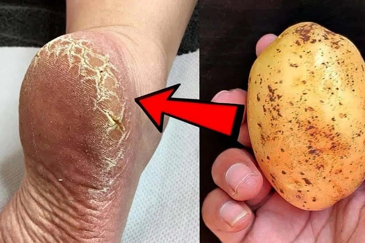 Como acabar com as rachaduras dos pés com uma dica de podólo