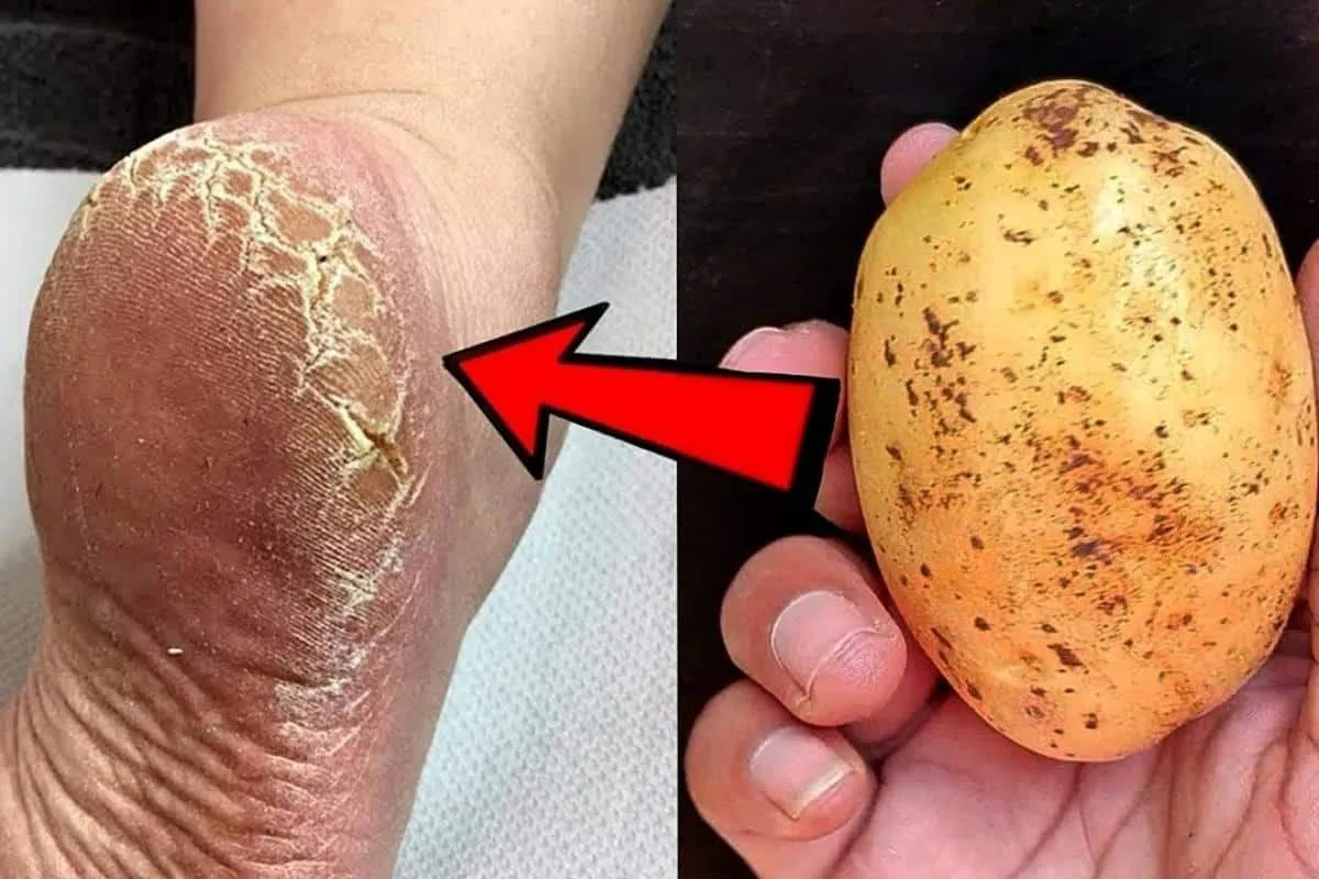 Como acabar com as rachaduras dos pés: não precisa gastar na