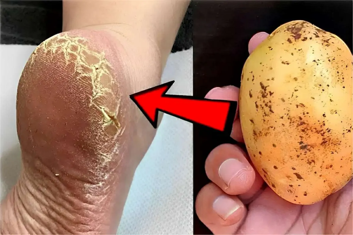 Como acabei com as rachaduras do pé usando um ingrediente na