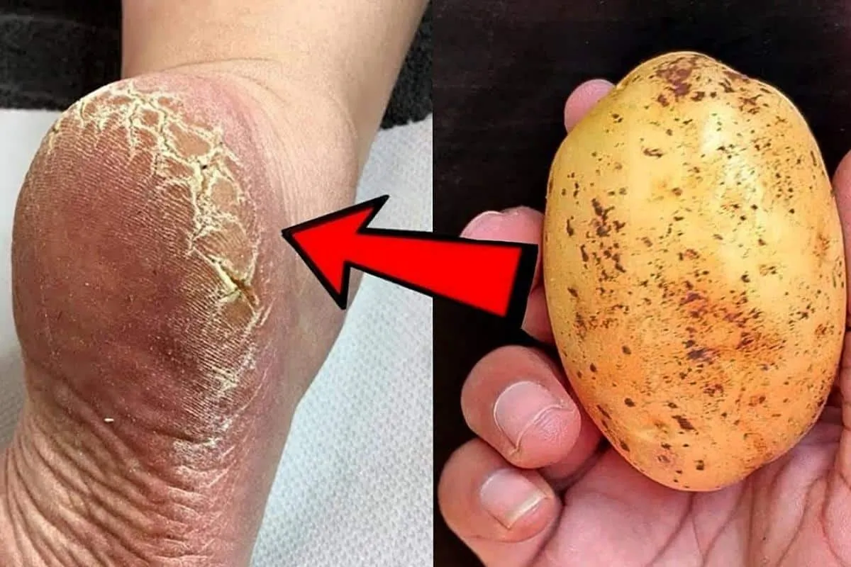 Como acabei com as rachaduras dos meus pés sem precisar ir n