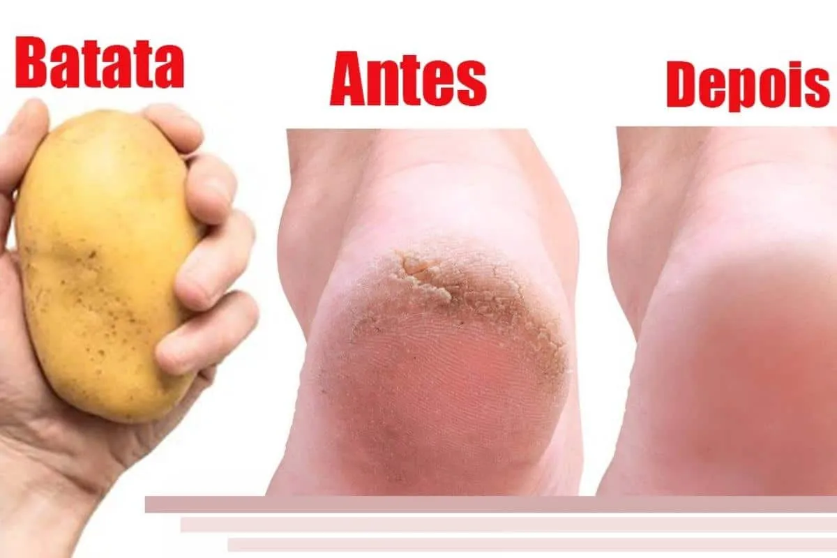 Como deixar os pés lisos: acabe com as rachaduras sem usar c