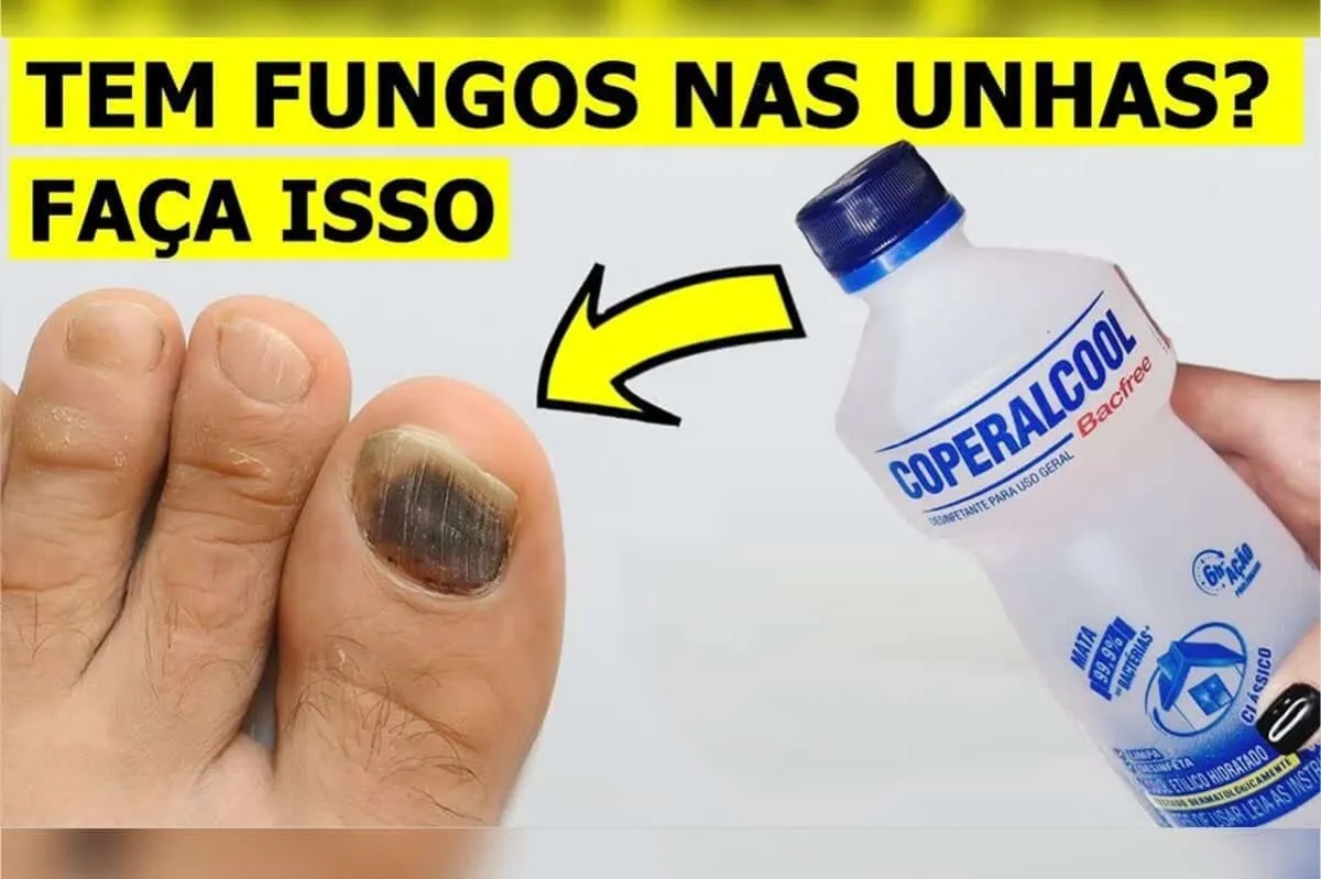 Como eliminar fungos das unhas: segredo de podologia que nun