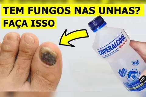 Como eliminar fungos das unhas: segredo de podologia que nun