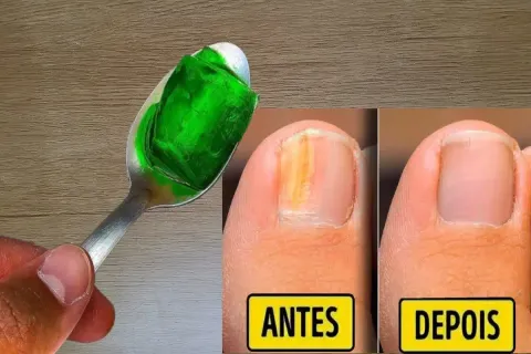 Como eliminar micose da unha: a melhor dica caseira para voc