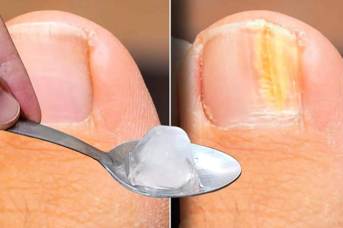 Como remover micose da unha sem precisa comprar cosmético ca