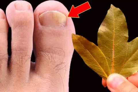 Como tirar micose da unha: segredo que uma podóloga me ensin