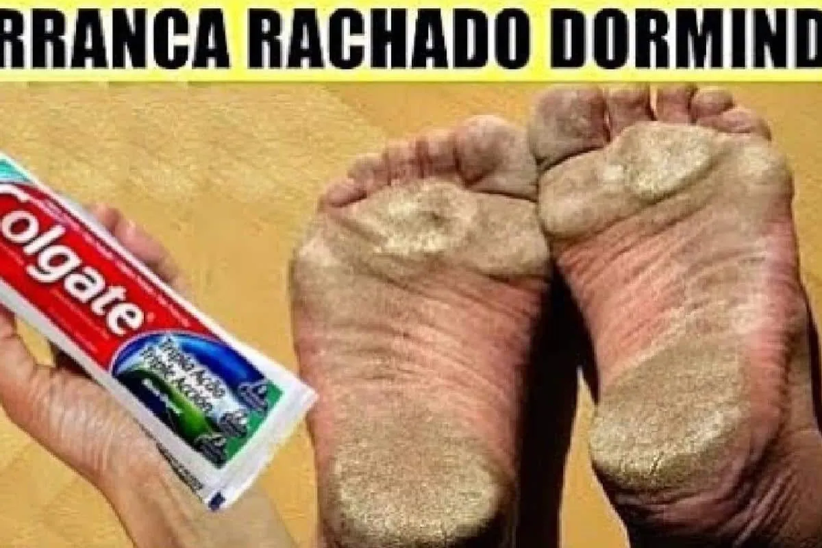 Como tirar rachadura dos pés: veja como ter pés lisinhos e s