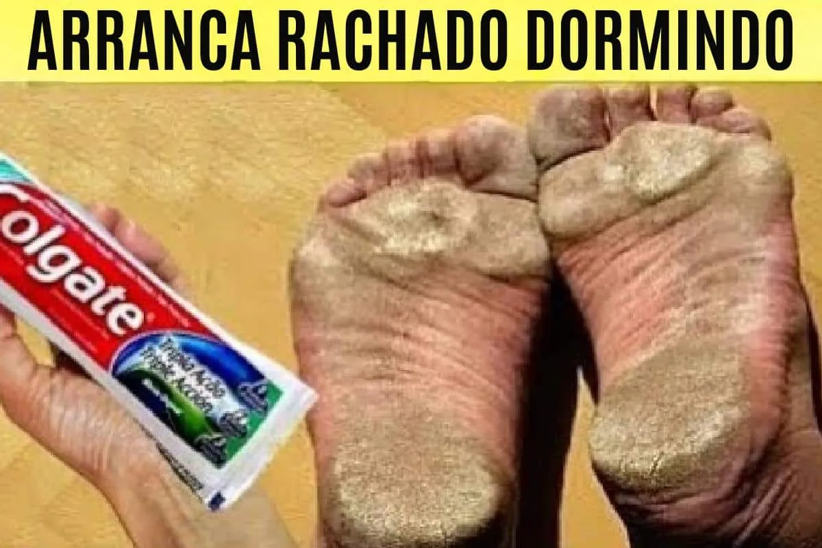 Como tirar rachaduras dos pés: a solução definitiva que você