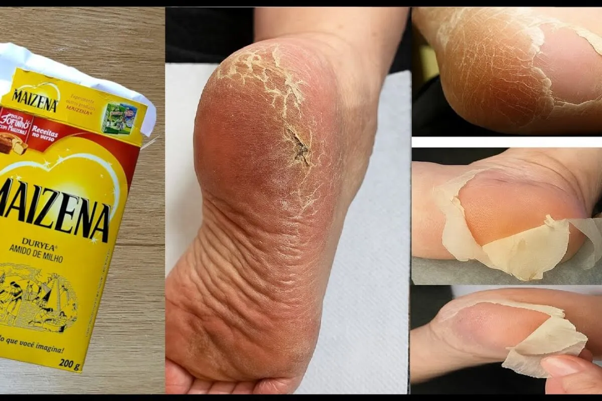 Como tirar rachaduras dos pés com receita simples que funcio
