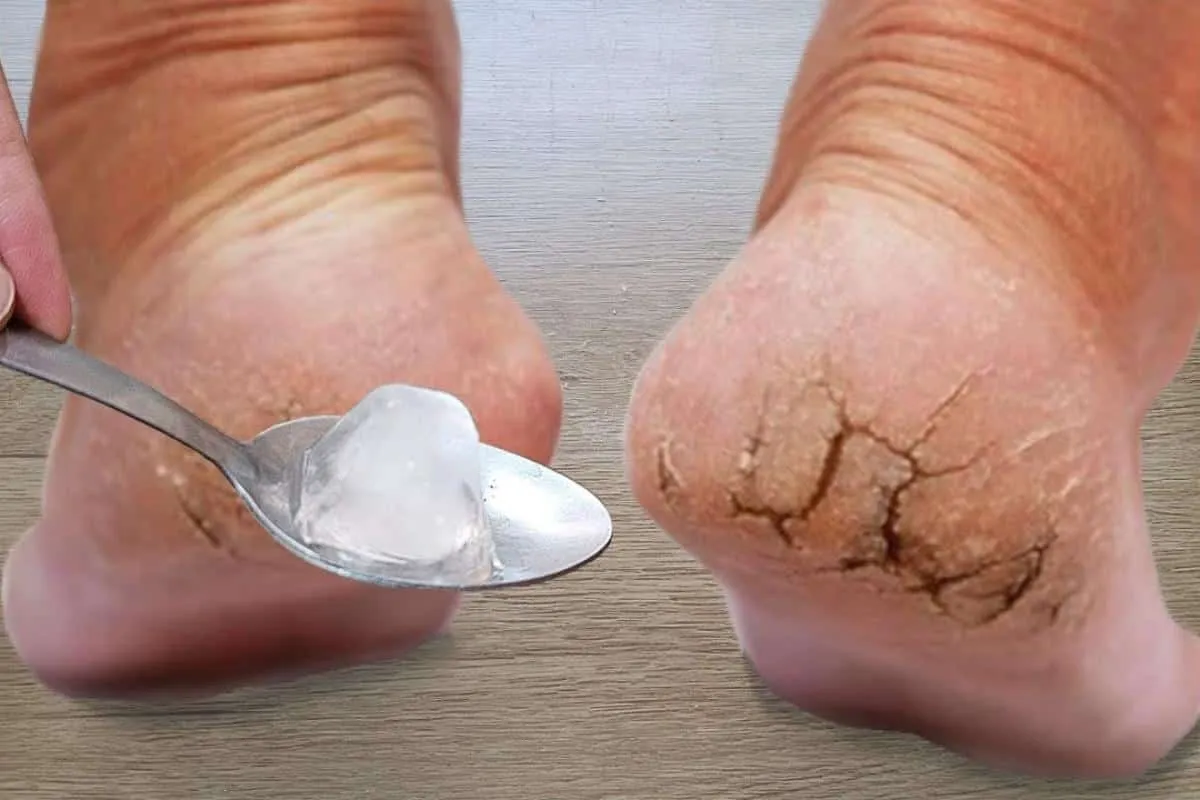Como tirar rachaduras dos pés: segredo de podóloga profissio