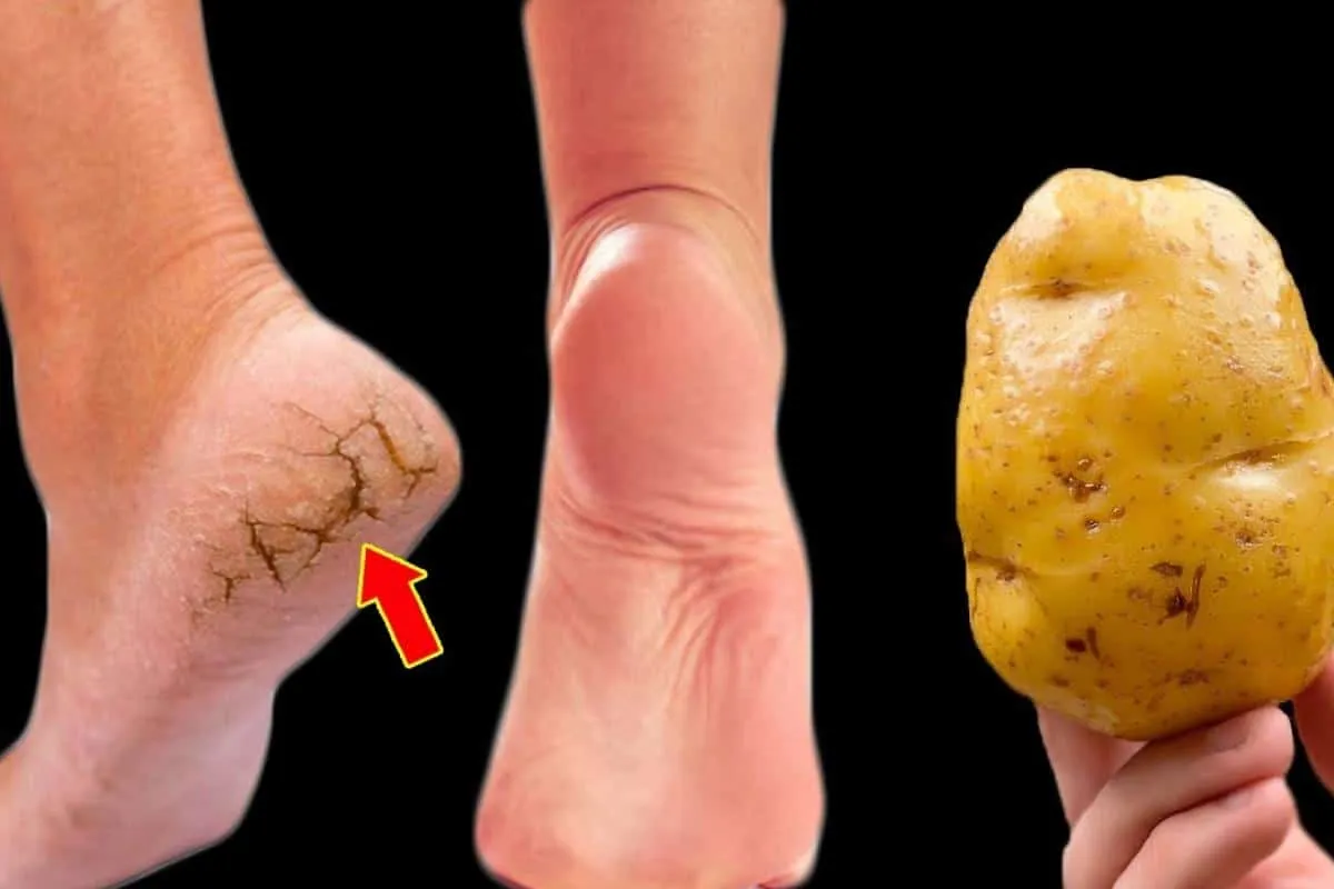 Como tirar rachaduras dos pés: uma podóloga profissional me