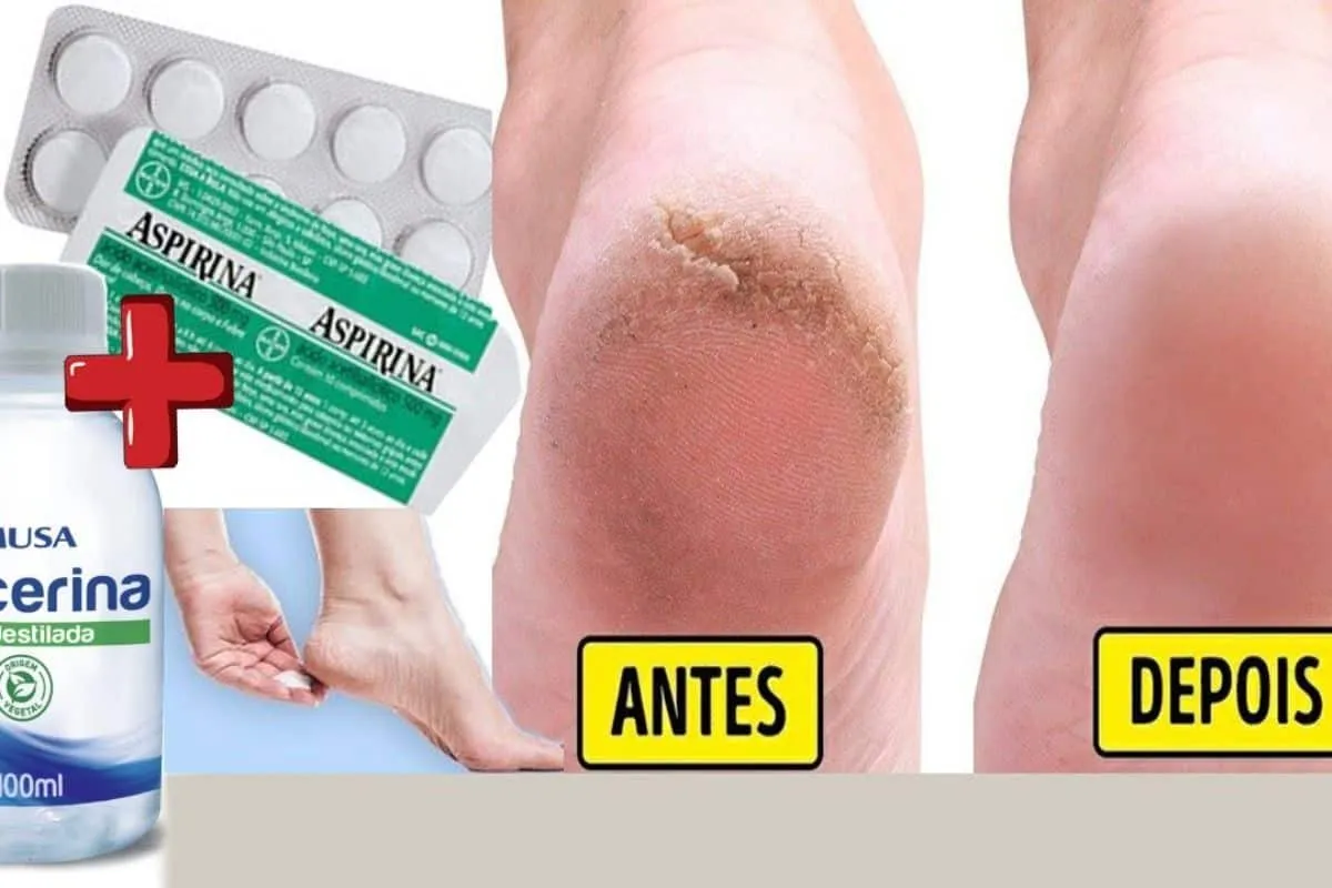 Dica de hidratante caseiro para pés rachados: seus pés lisin
