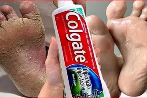 Dica para pés ressecados: tira as rachaduras e calosidades e