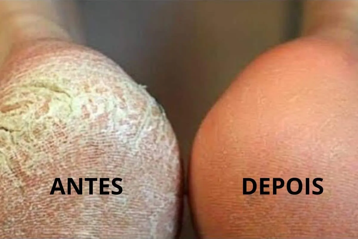 Seus problemas acabaram: ótima dica para pés ressecados e co