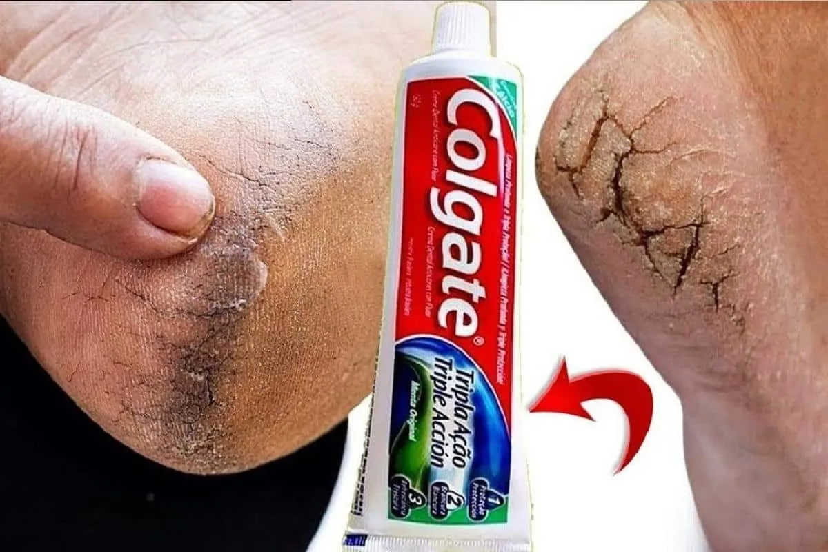 Siga essa dica para pés rachados e deixe seus pés lisos pare