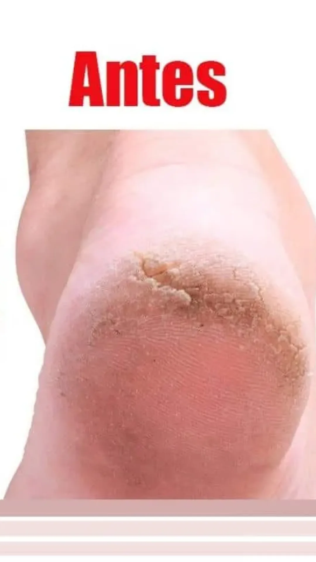 Como deixar os pés lisos: acabe com as rachaduras sem usar cosméticos