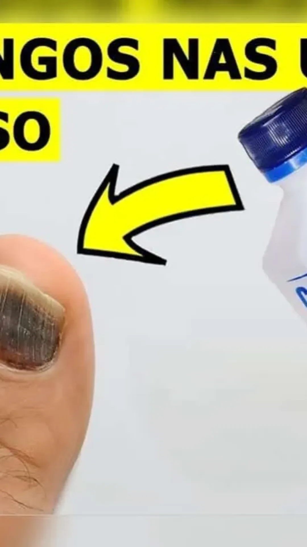 Como eliminar fungos das unhas: segredo de podologia que nunca te contaram