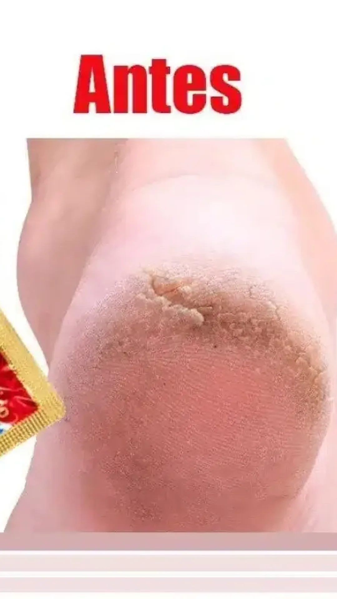 Como hidratar pés rachados e ressecados sem precisar de cosmético caro de farmácia