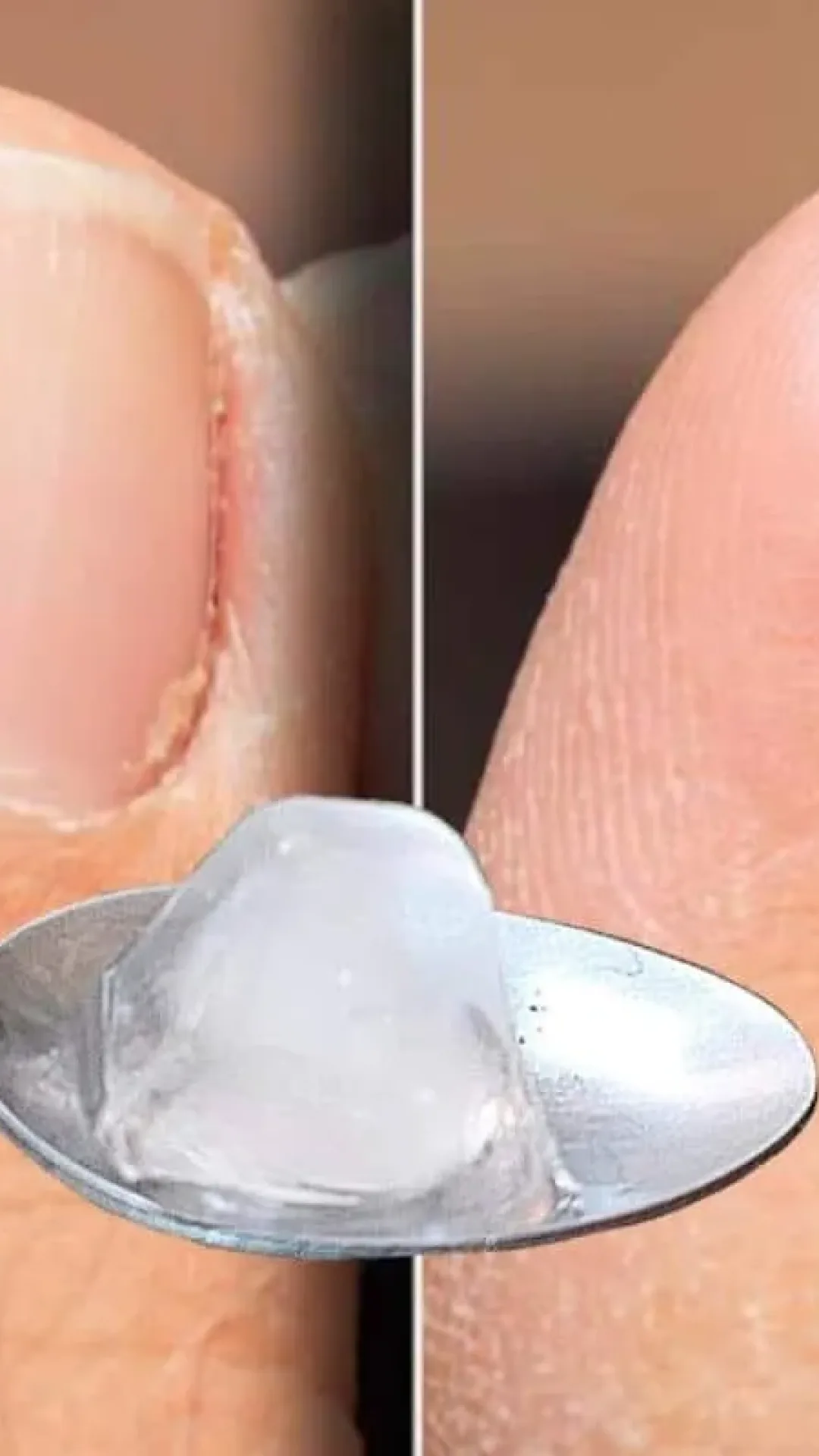 Como remover micose da unha sem precisar gastar dinheiro com cosmético caro