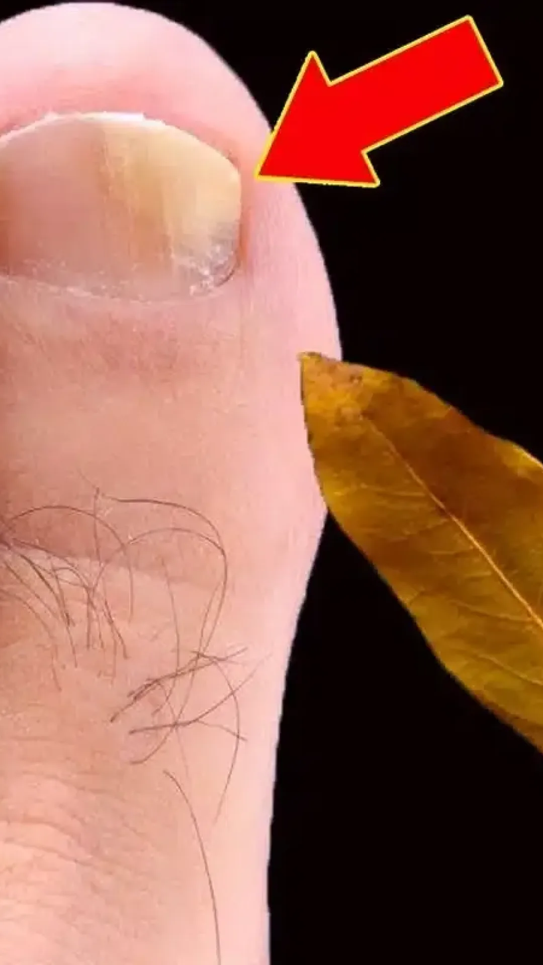 Como tirar micose da unha: segredo que uma podóloga me ensinou sem cobrar nada