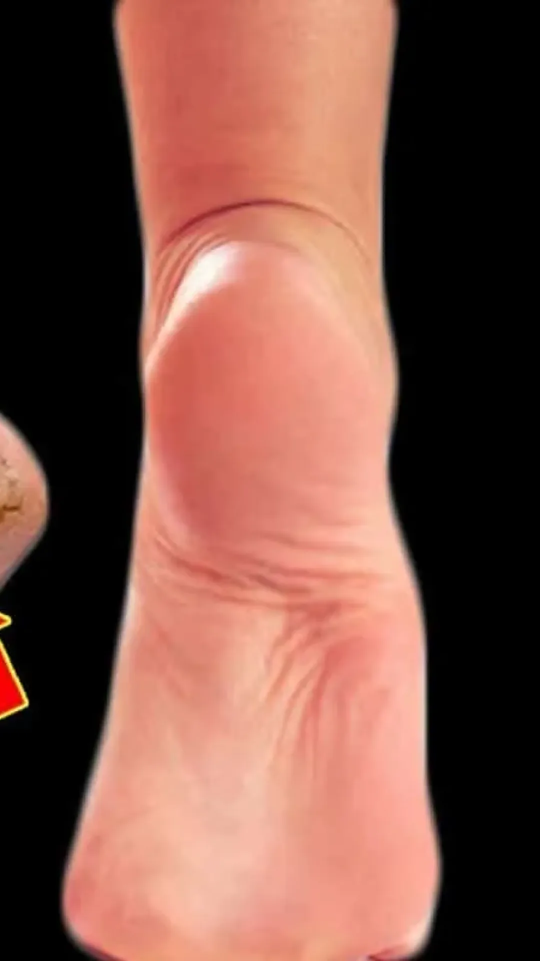 Como tirar rachaduras dos pés: uma podóloga profissional me ensinou um segredo incrível