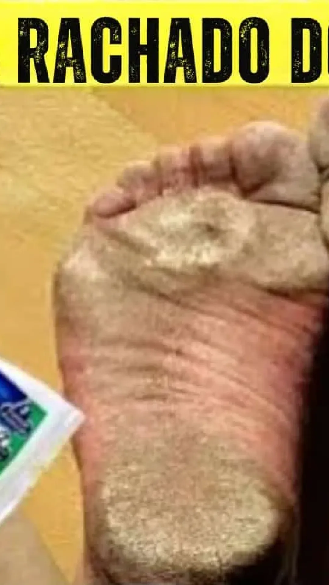 Dica para pés rachados e com calos: seus pês vão ficar lisinhos novamente